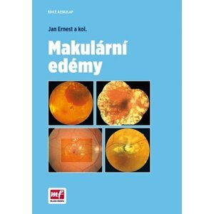 Makulární edémy - Jan Ernest