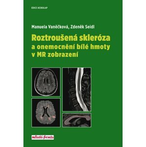 Roztroušená skleróza a onemocnění bílé hmoty v MR zobrazení - Zdeněk Seidl